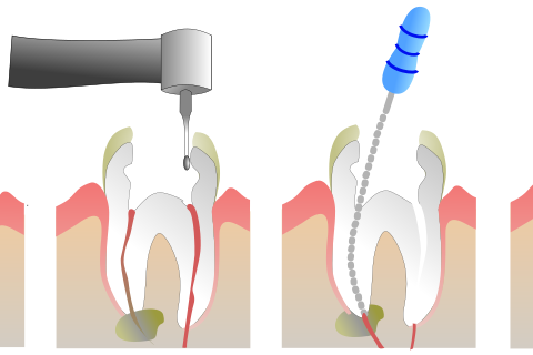 ROOT CANAL TREATMENT